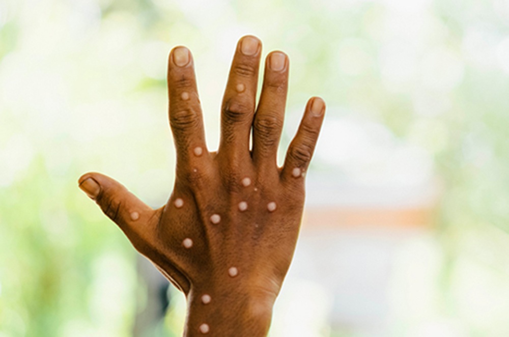 Kemenkes Pastikan Kasus Siswa Meninggal di Riau Bukan Karena Monkeypox
